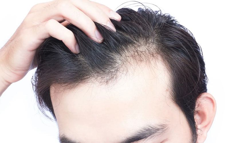 کاشت مو | کاشت مو طبیعی | کاشت مو پرتراکم | پیوند مو