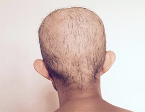 ریزش مو بعد از شیمی درمانی
