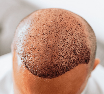 کاشت مو در بیماران سرطانی
