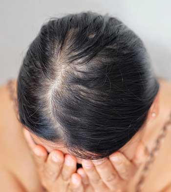 کاشت مو زنان برای درمان کم پشتی و ریزش مو