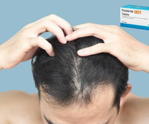 مصرف فیناستراید بعد از کاشت مو