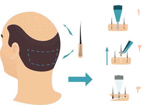 کاشت مو به روش fit چگونه انجام می شود؟