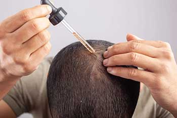 فواید استفاده از ماینوکسیدیل بعد کاشت مو