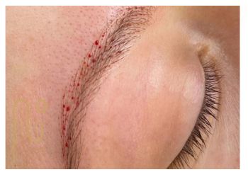 خونریزی بعد از کاشت ابرو به روش FUT