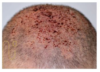 علت جوش بعد از کاشت مو