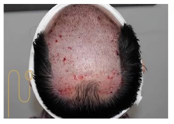 انواع فولیکولیت بعد از کاشت مو