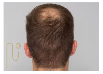Causes-of-transplanted-hair-loss علت ریزش موهای کاشته شده
