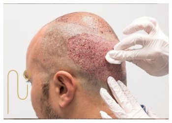Excision-of-wounds-after-hair-transplantation کندن زخم های بعد از کاشت مو