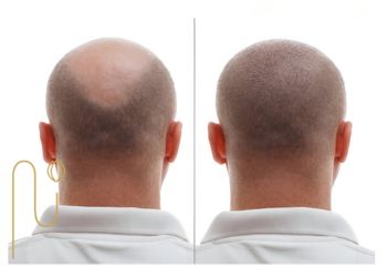 Photo-of-hair-loss-after-transplantation عکس ریزش مو بعد از کاشت