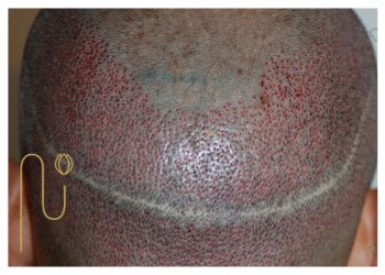 Photo-of-hair-transplant -wound عکس زخم کاشت مو