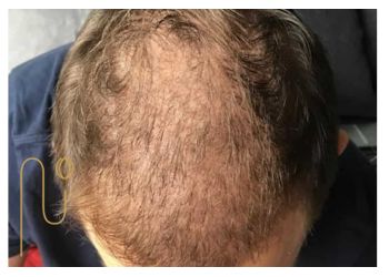 Stages-of-hair-loss-after-transplantation مراحل ریزش مو بعد از کاشت