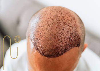 Comparison-of-micro-scalping-and-hair-transplantation-results مقایسه نتیجه میکرو اسکالپ و کاشت مو