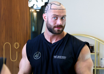 The-effect-of-bodybuilding-on-hair-transplant-results تاثیر بدنسازی بر نتیجه کاشت مو