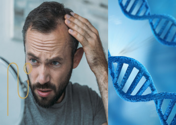 The-impact-of-genetics-on-hair-transplantation تاثیر ژنتیک بر کاشت مو