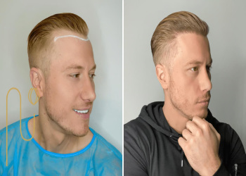 hair-transplant-or-hair-restoration کاشت مو بهتر است یا ترمیم مو