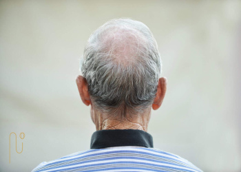 Complications-of-hair-transplantation-for-elderly عوارض کاشت مو برای سالمندان