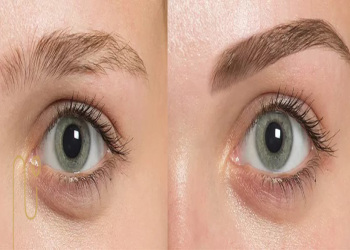 هزینه کاشت ابرو با مو افراد دیگر