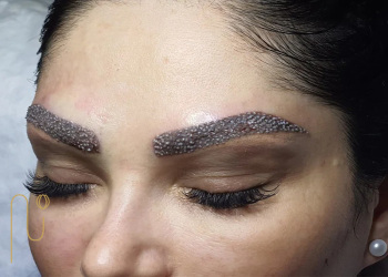 هزینه کاشت ابرو برای افراد دیابتی