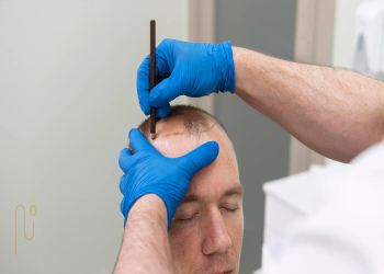 Hair-transplant-results-in-the-elderly نتایج کاشت مو در سالمندان