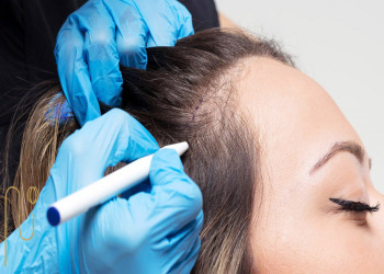 Hair-transplantation-and-pregnancy کاشت مو و اقدام به بارداری