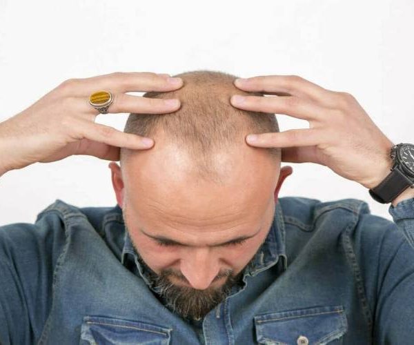 سوزش پشت سر بعد از کاشت مو