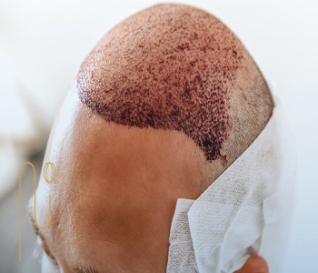 مصرف سیر بعد از کاشت مو برای تقویت سیستم ایمنی