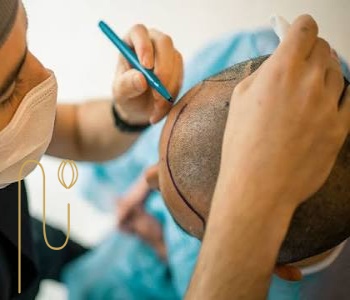 آیا تیروئید بر نتایج کاشت مو تأثیر می‌گذارد؟