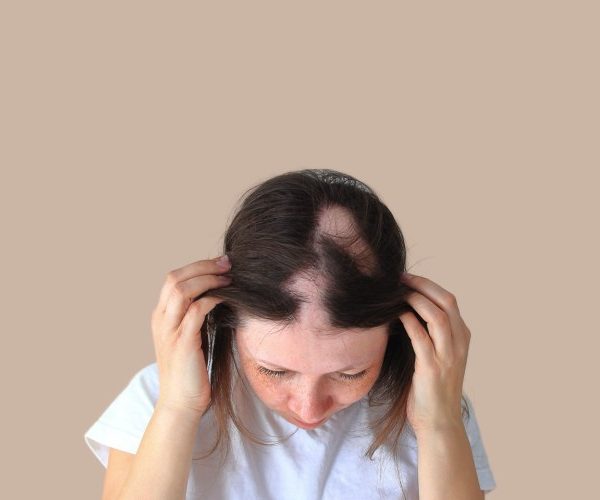 کاشت مو برای بیماران آلوپسی آره تا