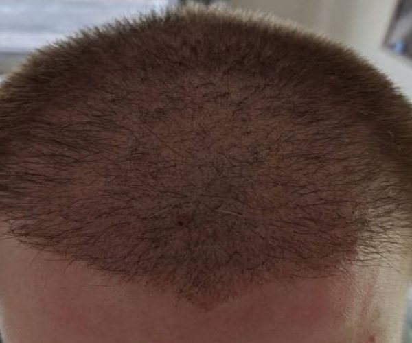 مدت زمان محکم شدن گرافت مو بعد از کاشت