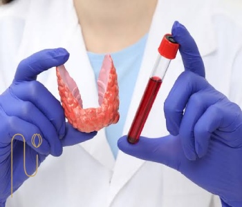 کم کاری تیروئید و کاشت مو