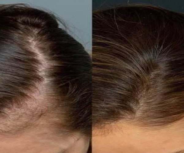 پی آر پی بهتر است یا فیلر مو | مقایسه هیر فیلر و پی ار پی