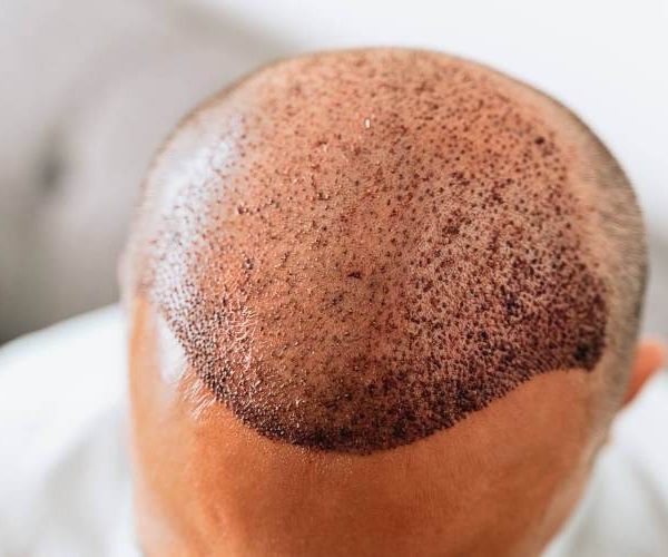 سفت شدن پوست سر بعد از کاشت مو