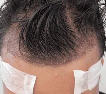 عرق کردن بعد از کاشت مو