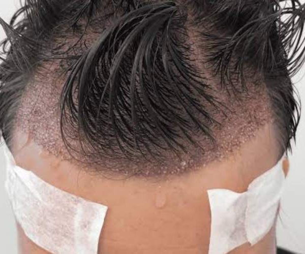 عرق کردن بعد از کاشت مو